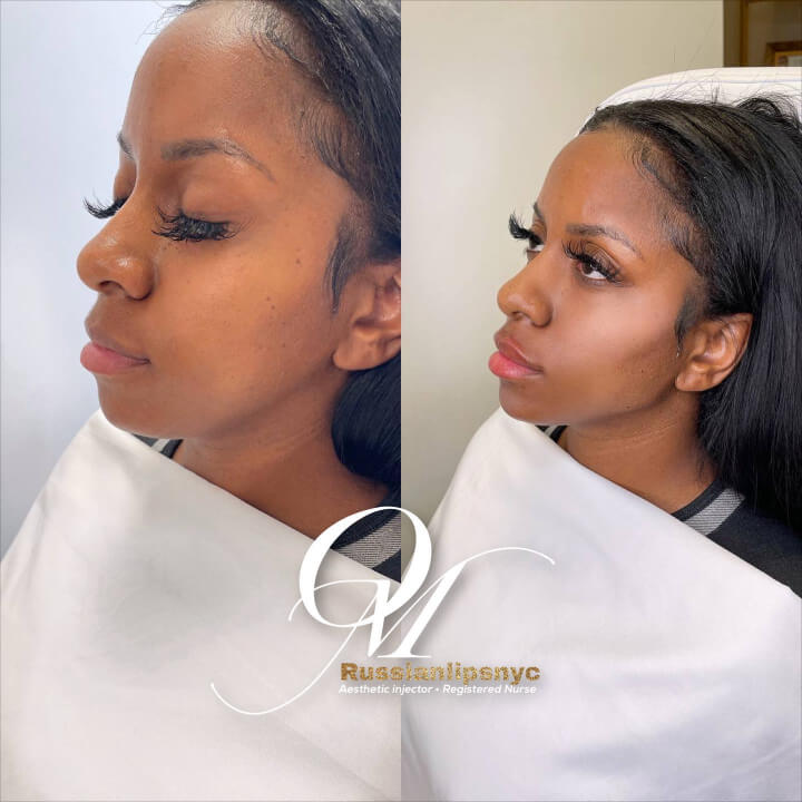 Full Face Beautification