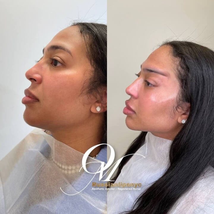 Full Face Beautification