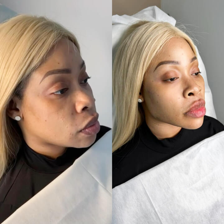 Full Face Beautification