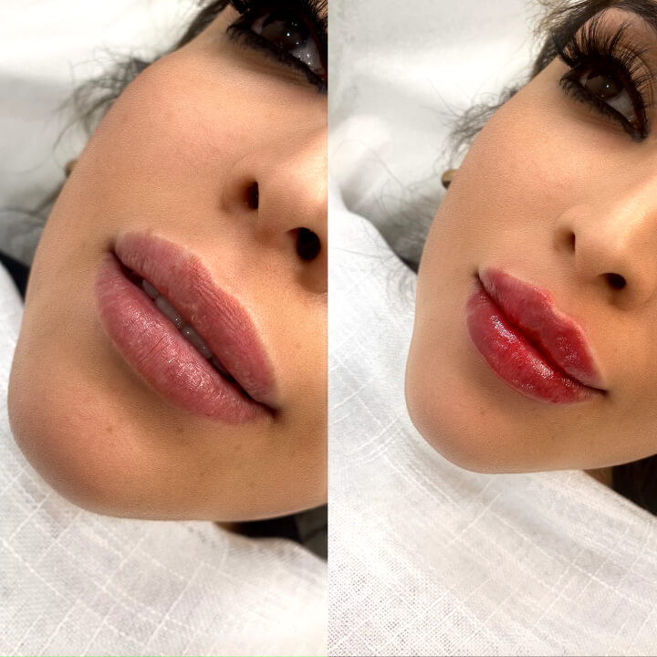 Lip Filler