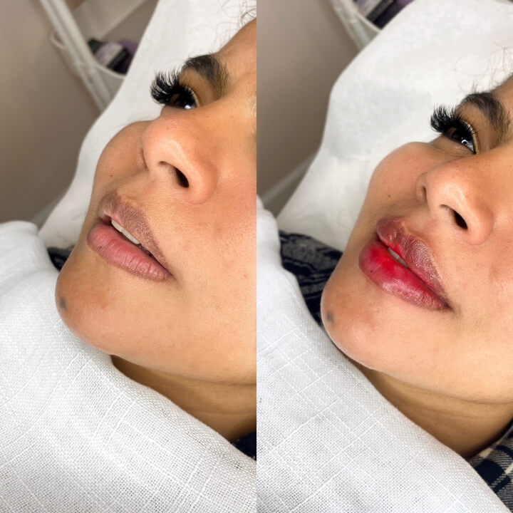 Lip Filler
