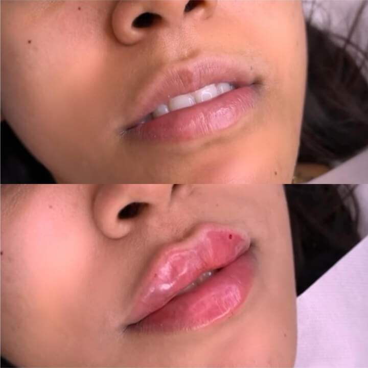 Lip Filler