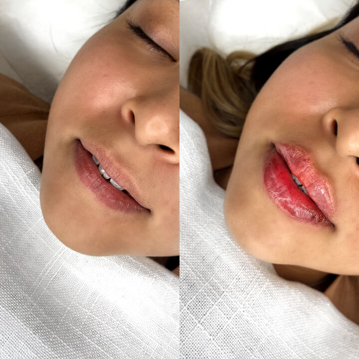 Lip Filler
